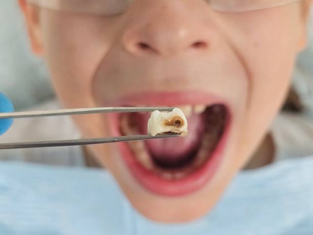 Best Emergency Tooth Extraction in Thibodaux, LA